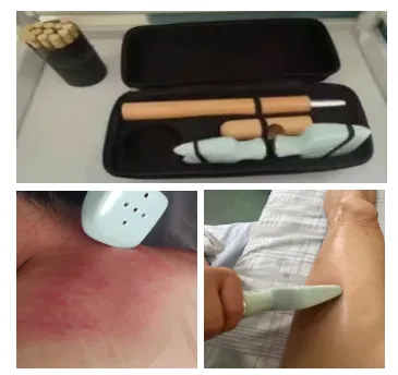 中医特色疗法——棍针拨筋疗法